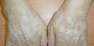 vitiligo.jpg
