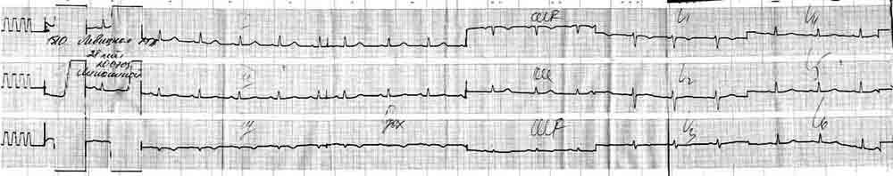 ekg3.jpg