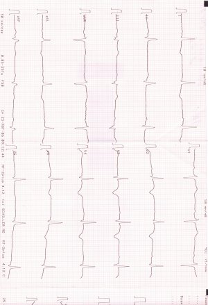 ЭКГ ОЧ начало.jpg