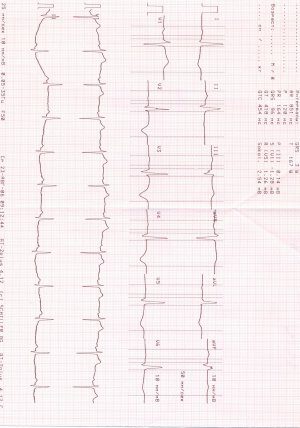 ЭКГ ОЧ продолжение.jpg