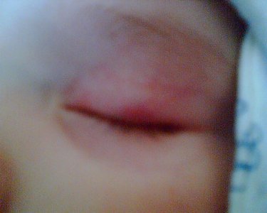 Веко при болезни.jpg