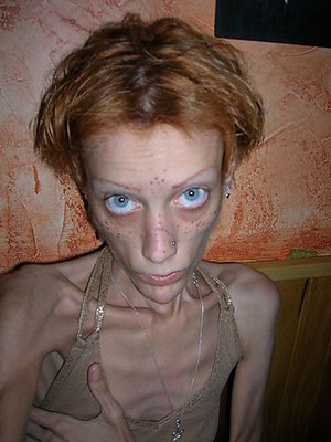 anorexia.jpg