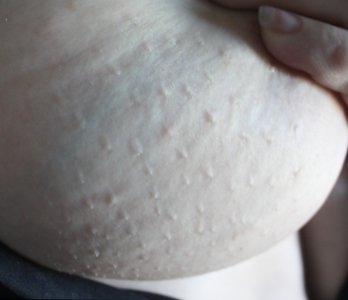 пупыри.jpg пупыри.jpg