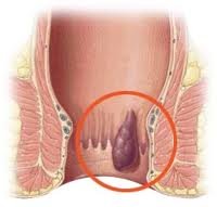vnutrenniy-gemorroy.jpg vnutrenniy-gemorroy.jpg