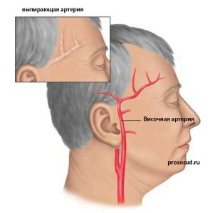 vipiraet-arteriya-viska.jpg vipiraet-arteriya-viska.jpg