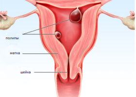 полип-эндометрия.png