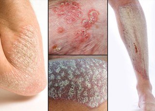 Psoriaz-prichiny-vozniknoveniya-simptomy-i-priznaki-diagnostika-i-lechenie_big.jpg Psoriaz-prichiny-vozniknoveniya-simptomy-i-priznaki-diagnostika-i-lechenie_big.jpg