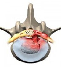 лечение грыжи позвоночника в Израиле2.jpg