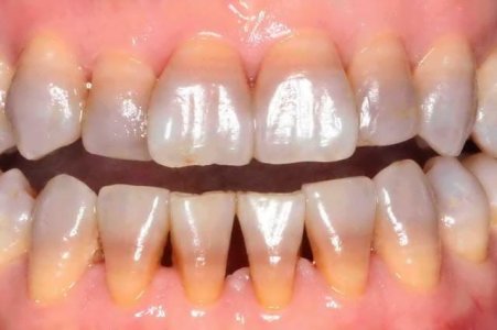 tetracycline_teeth.jpg tetracycline_teeth.jpg