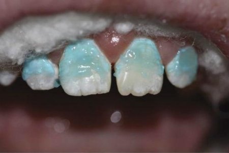 КАЛЬЦИНОЗ ЗУБОВ.jpg